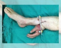Cirujanos injertan la mano de un hombre en su pierna