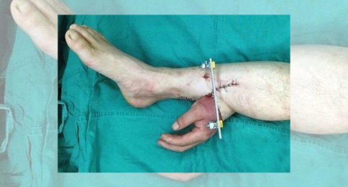 Cirujanos injertan la mano de un hombre en su pierna