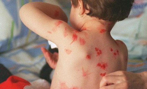 Advierten sobre considerable aumento de varicela en niños