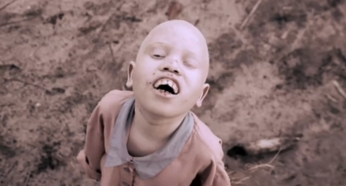 ¿Por qué los albinos de África son acechados por brujos y traficantes?