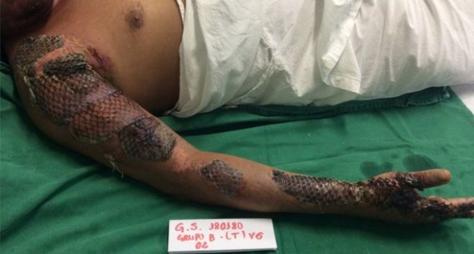 Mencionan que aún no es posible que piel de tilapia sea utilizada para curar quemaduras en nuestro país