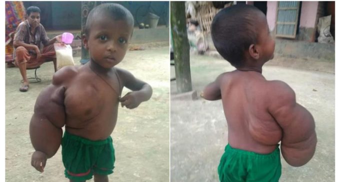Niña de dos años apenas puede caminar o estar parada por un tumor en el brazo