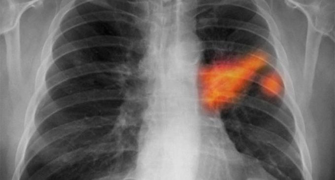 El 90% de los casos de cáncer pulmonar está relacionado al tabaquismo